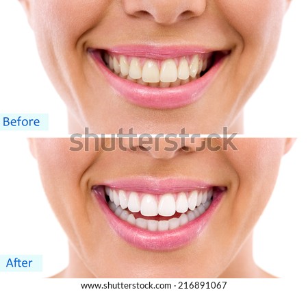 whitening - bleaching treatment ,before and after ,woman teeth and smile, close up, isolated on white  Royalty-Free Stock Photo #216891067