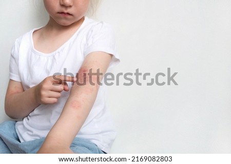 The child scratches atopic skin. Dermatitis, diathesis, allergy on the child's body.irritation and pruritus. Royalty-Free Stock Photo #2169082803