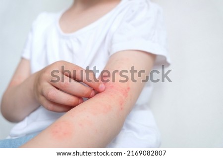The child scratches atopic skin. Dermatitis, diathesis, allergy on the child's body.irritation and pruritus. Royalty-Free Stock Photo #2169082807