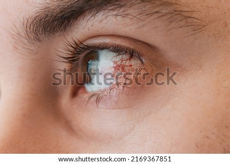 Ophthalmology. Human eye close-up with red vascular mesh and inflammation on the eyeball. The concept of conjunctivitis and keratitis. Royalty-Free Stock Photo #2169367851