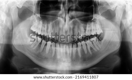 X-ray radiograph picture showing human jaw and teeth