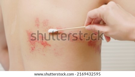 close up of apply ointment with shingles disease on skin Royalty-Free Stock Photo #2169432595