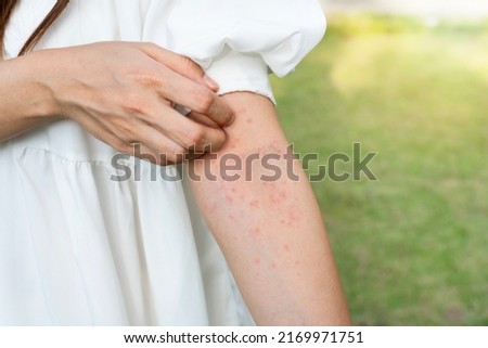 Closeup of woman hand scratching her skin itchy. Allergic rash dermatitis eczema skin, insect, food allergy, health care concept Royalty-Free Stock Photo #2169971751