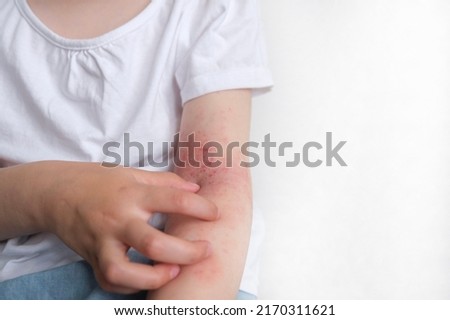The child scratches atopic skin. Dermatitis, diathesis, allergy on the child's body. Royalty-Free Stock Photo #2170311621