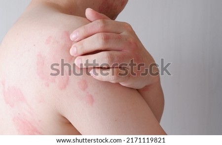 Close up image of skin texture suffering severe urticaria or hives or kaligata. Allergy symptoms. Royalty-Free Stock Photo #2171119821