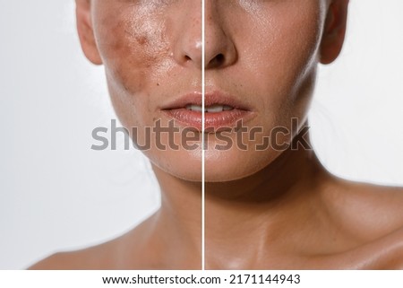 Hyperpigmentation of female skin, close-up of a part of the face on a white background, before and after acid peeling and cosmetic therapy, dermatology, skin care Royalty-Free Stock Photo #2171144943