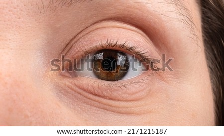 female eye closeup, keratoconus disease of the cornea. Royalty-Free Stock Photo #2171215187