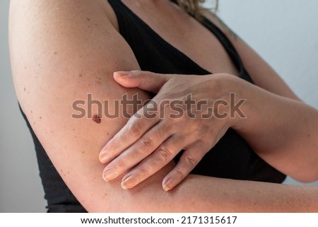 a large and unusual mole or freckle on a woman's arm was diagnosed as malignant melanoma skin cancer Royalty-Free Stock Photo #2171315617