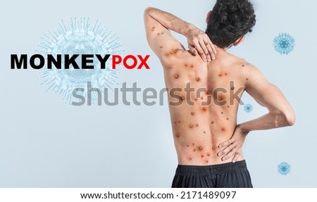 People with monkeypox on isolated background, A person from back with monkeypox on his body, Monkeypox virus concept, Monkeypox virus outbreak pandemic design Royalty-Free Stock Photo #2171489097