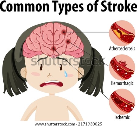 Human with common types of stroke illustration