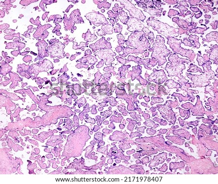 
Human placenta. Erythroblastosis fetalis. Placental villus showing oedema, abundance of Hofbauer cells, persistent cytotrophoblast and abundance of syncytial knots Royalty-Free Stock Photo #2171978407