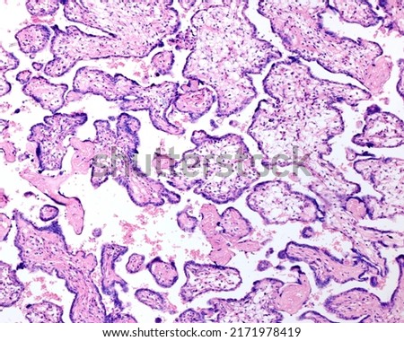 
Human placenta. Erythroblastosis fetalis. Placental villus showing oedema, abundance of Hofbauer cells, persistent cytotrophoblast and abundance of syncytial knots Royalty-Free Stock Photo #2171978419