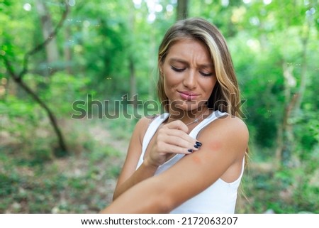 Itchy insect bite - Irritated young female scratching her itching arm from a mosquito bite at the park during summertime. Royalty-Free Stock Photo #2172063207