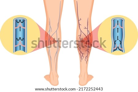 Human legs with varicose vein illustration Royalty-Free Stock Photo #2172252443