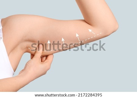 Arm of young woman after slimming on light background. Plastic surgery concept Royalty-Free Stock Photo #2172284395