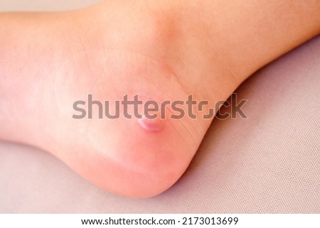 detail of the heel of a girl with a reddened blister Royalty-Free Stock Photo #2173013699