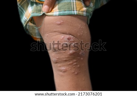 Scabies Infestation with secondary or superimposed bacterial infection and pustules in leg of Southeast Asian, Burmese child. Royalty-Free Stock Photo #2173076201