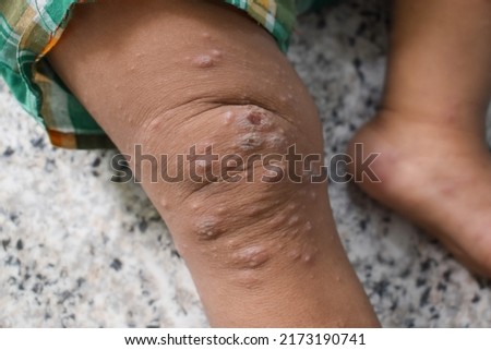 Scabies Infestation with secondary or superimposed bacterial infection and pustules in leg of Southeast Asian, Burmese child. Royalty-Free Stock Photo #2173190741