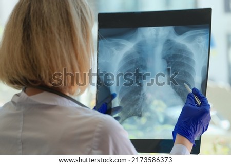 Doctor examines chest x-ray of patient in hospital. Pneumonia or bronchitis on medical pictures concept