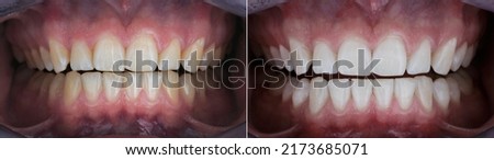 dental photo comparison before and after teeth whitening Royalty-Free Stock Photo #2173685071