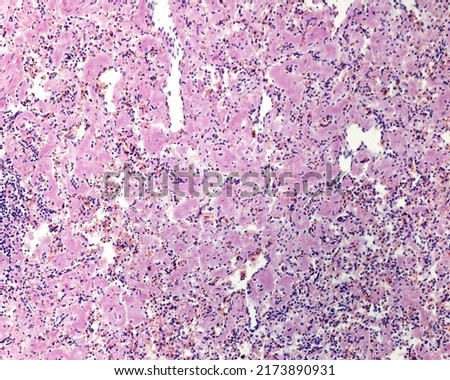 Human spleen amyloidosis. The spleen is involved in most cases of systemic amyloidosis. The micrograph shows a “lardaceous spleen” form in which amyloid is deposited in the walls of the sinusoids Royalty-Free Stock Photo #2173890931
