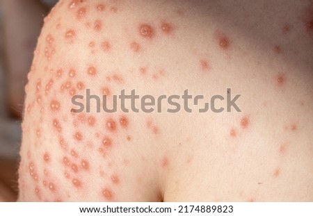 little baby boy with severe form of varicella,chickenpox virus.lot of blisters on child body.nettle rash spread over the all body,most of them in shoulder,neck and hands area.kid lying on bed,fever Royalty-Free Stock Photo #2174889823