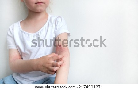 The child scratches atopic skin. Dermatitis, diathesis, allergy on the child's body. Royalty-Free Stock Photo #2174901271