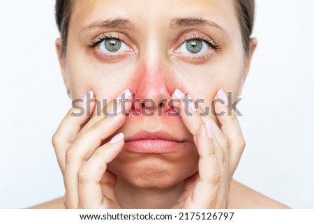 A young caucasian sad woman with a red rash near the nose touches the face with her hands isolated on white background. Worried girl sneezes from allergy  Royalty-Free Stock Photo #2175126797