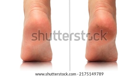 Image before and after feet dry skin cracked heel treatment. Cracked heels before and after treatment and treatment. Medical pedicure in a beauty salon. Problematic dehydrated feet with dry skin. Royalty-Free Stock Photo #2175149789