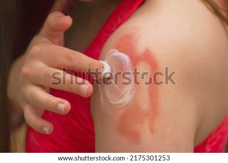 Sunburn,Allergic reaction, itching, allergy, dermatitis. Close-up of a woman applying cream or ointment to swollen skin after a mosquito bite, isolated on a grey studio background.
