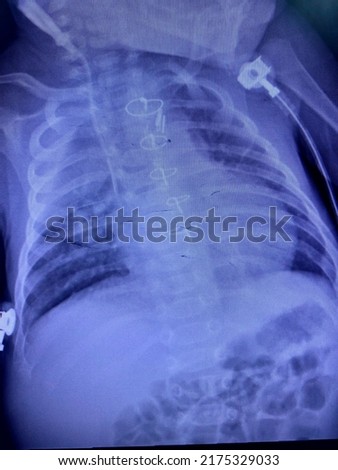 Film x-ray show right upper lung atelectasis for medical and technology concept 