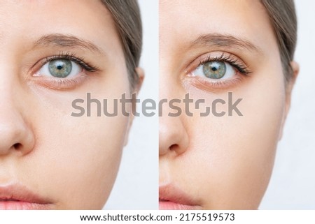 Cropped shot of young caucasian woman's face with drooping upper eyelid before and after plastic surgery isolated on white background. Result of blepharoplasty. Changing the shape, cut of the eyes Royalty-Free Stock Photo #2175519573