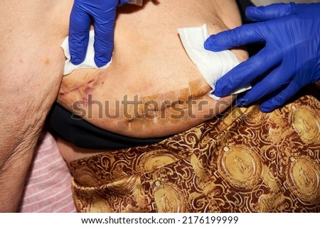 first cure after breast surgery in an octogenarian woman Royalty-Free Stock Photo #2176199999