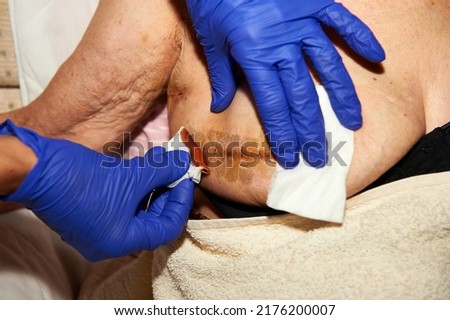 first cure after breast surgery in an octogenarian woman Royalty-Free Stock Photo #2176200007