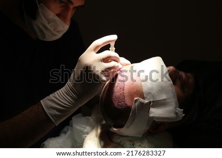 hair transplant patient during and after the surgery Royalty-Free Stock Photo #2176283327