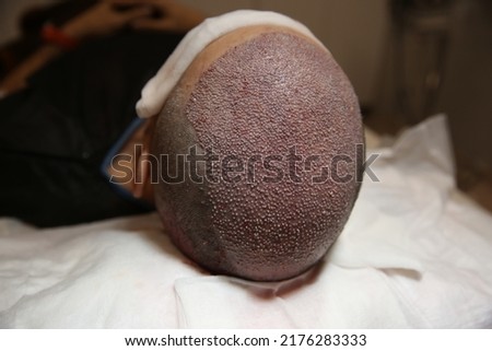 hair transplant patient during and after the surgery Royalty-Free Stock Photo #2176283333