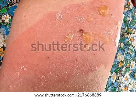 Burns from boiling water on the leg in the upper part. Blisters, dropsy from burns with hot water and steam Royalty-Free Stock Photo #2176668889