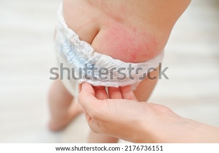 irritation on the skin of the baby from the diaper close-up. Royalty-Free Stock Photo #2176736151