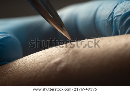 process of permanent hair removal, removing unwanted hair using an tweezers, close-up macro photography. Cosmetology procedure in beauty cabinet.
