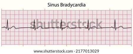 ECG line: Sinus Bradycardia in 6 second ECG paper line Royalty-Free Stock Photo #2177013029