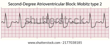 ECG line: Second-Degree Atrioventricular Block: Mobitz type 2 in 6 second ECG paper line Royalty-Free Stock Photo #2177038185