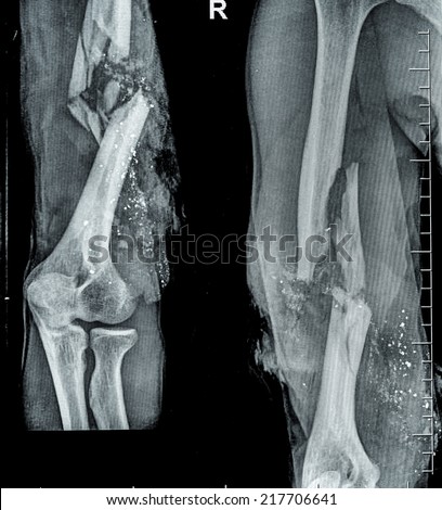 X-ray image  fracture  bone