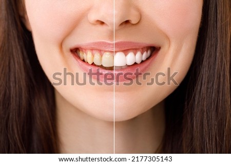 Smiling woman before and after the teeth whitening procedure, close-up image. Royalty-Free Stock Photo #2177305143