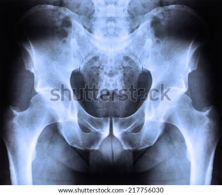 X -ray of human spine and pelvis