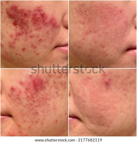Acne Before and After - Progress Royalty-Free Stock Photo #2177682119