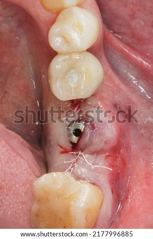 dental gingiva former after implantation Royalty-Free Stock Photo #2177996885