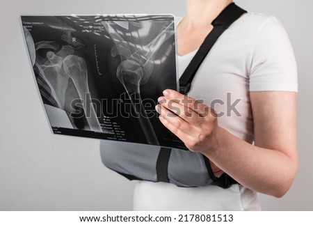 Woman wearing arm sling and looking at X-ray image. Female suffering from shoulder, clavicle, acromion fracture, strain. Health care, injury diagnostics concept. High quality photo Royalty-Free Stock Photo #2178081513