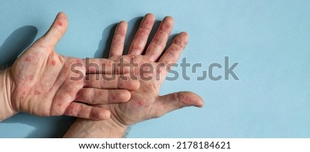 Male hands with Monkeypox rash. Patient with MonkeyPox viral disease. Close Up of Painful rash, red spots blisters on the skin. Human palm with Health problem. Banner, copy space. Allergy, dermatitis. Royalty-Free Stock Photo #2178184621