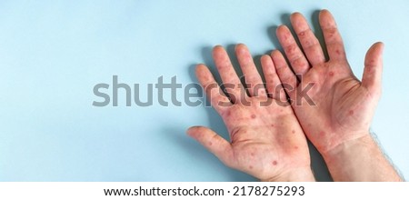 Male hands with Monkeypox rash. Patient with MonkeyPox viral disease. Close Up of Painful rash, red spots blisters on the skin. Human palm with Health problem. Banner, copy space. Allergy, dermatitis Royalty-Free Stock Photo #2178275293