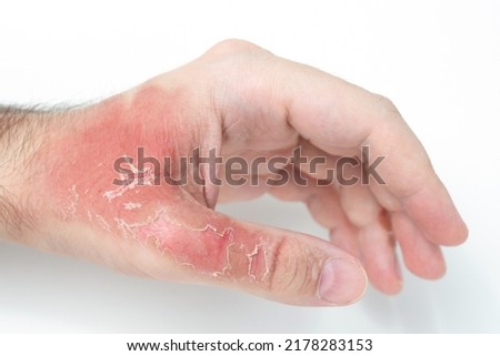 Man's hand with injuries and red dead skin on hand after thermal burn, domestic accident, careless behavior with boiling water on white background. Damage to hand after bursting glass with hot water. Royalty-Free Stock Photo #2178283153